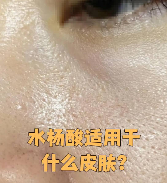 敏感肌可以用水杨酸吗