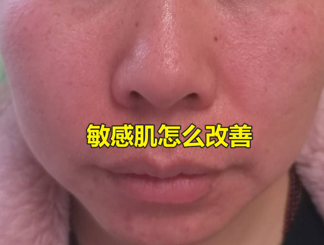 敏感肌怎么改善