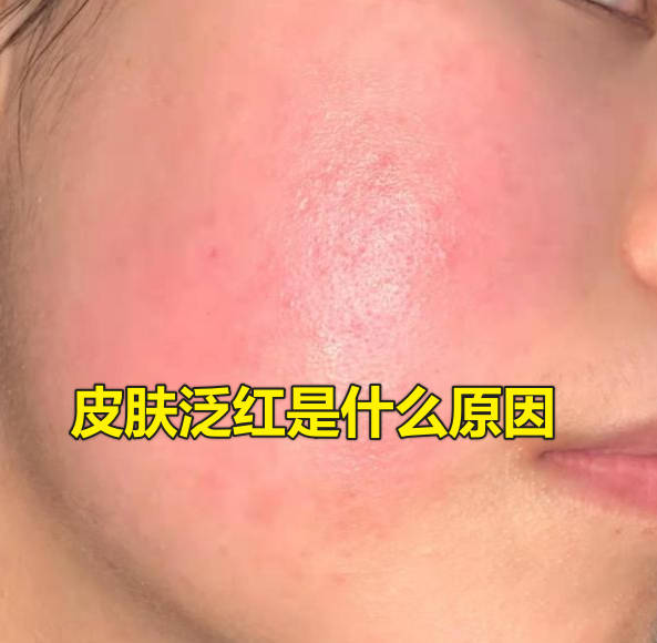 皮肤泛红