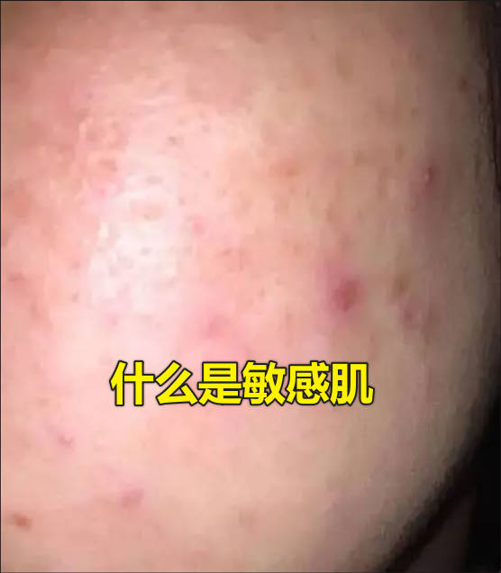 什么是敏感肌
