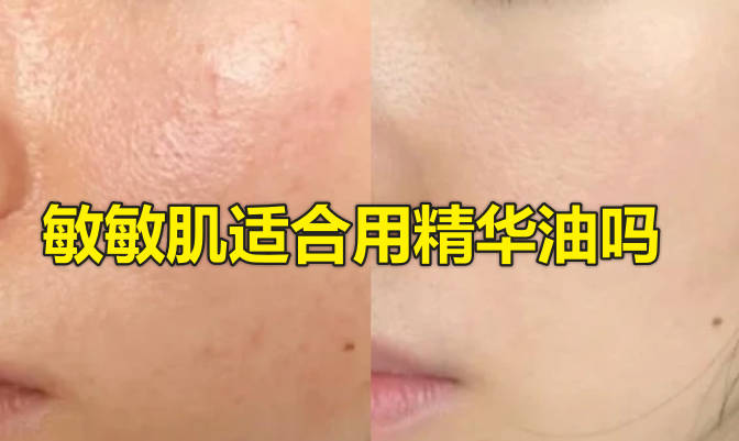 敏敏肌适合用精华油吗