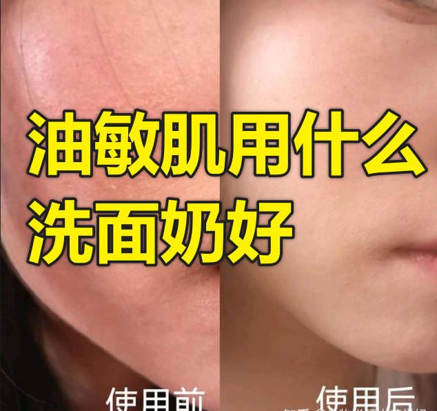 油敏肌用什么洗面奶好