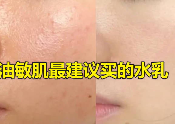 油敏肌最建议买的水乳